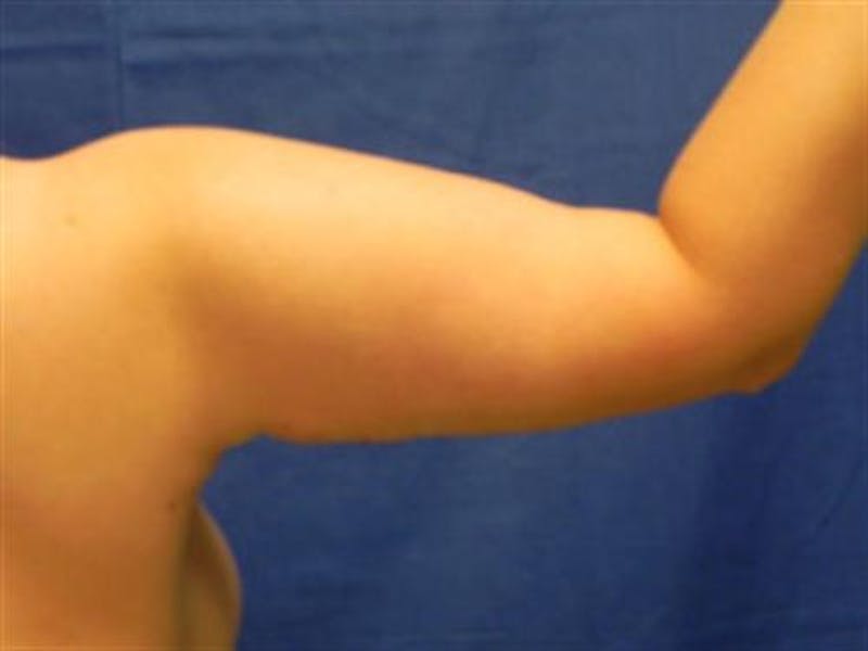 Arm Lift Before & After Gallery - Patient 174781 - Image 4