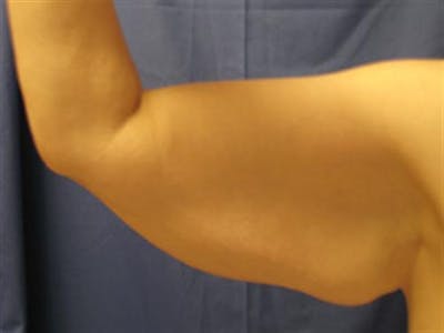 Arm Lift Before & After Gallery - Patient 297447 - Image 1