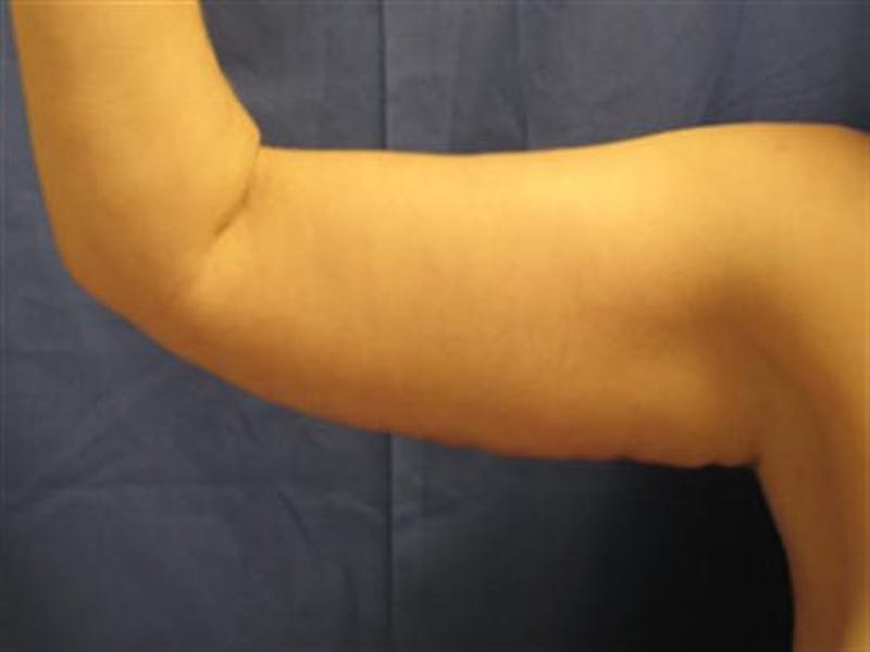 Arm Lift Before & After Gallery - Patient 297447 - Image 2