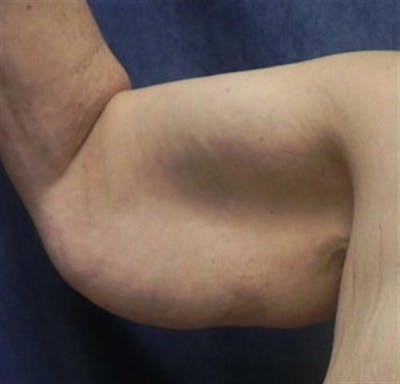 Arm Lift Before & After Gallery - Patient 260678 - Image 1
