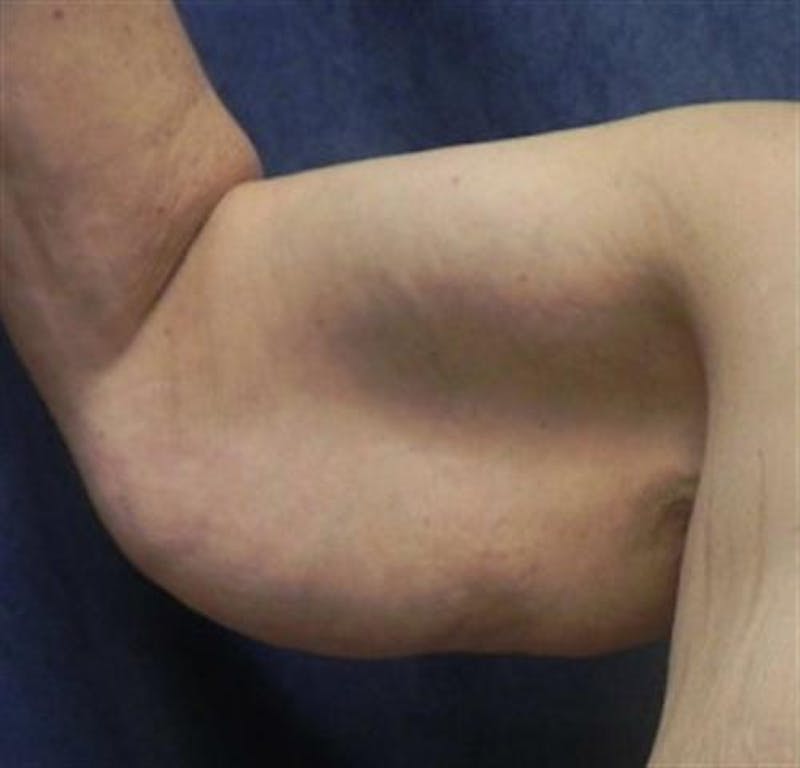 Arm Lift Before & After Gallery - Patient 260678 - Image 1