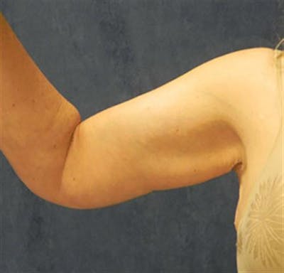 Arm Lift Before & After Gallery - Patient 260678 - Image 2