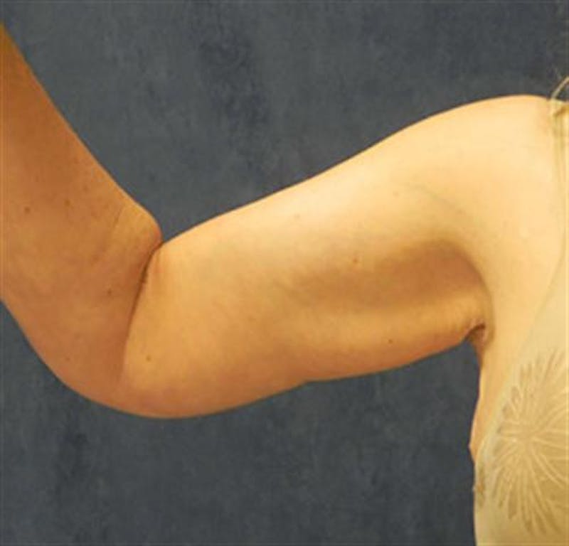 Arm Lift Before & After Gallery - Patient 260678 - Image 2