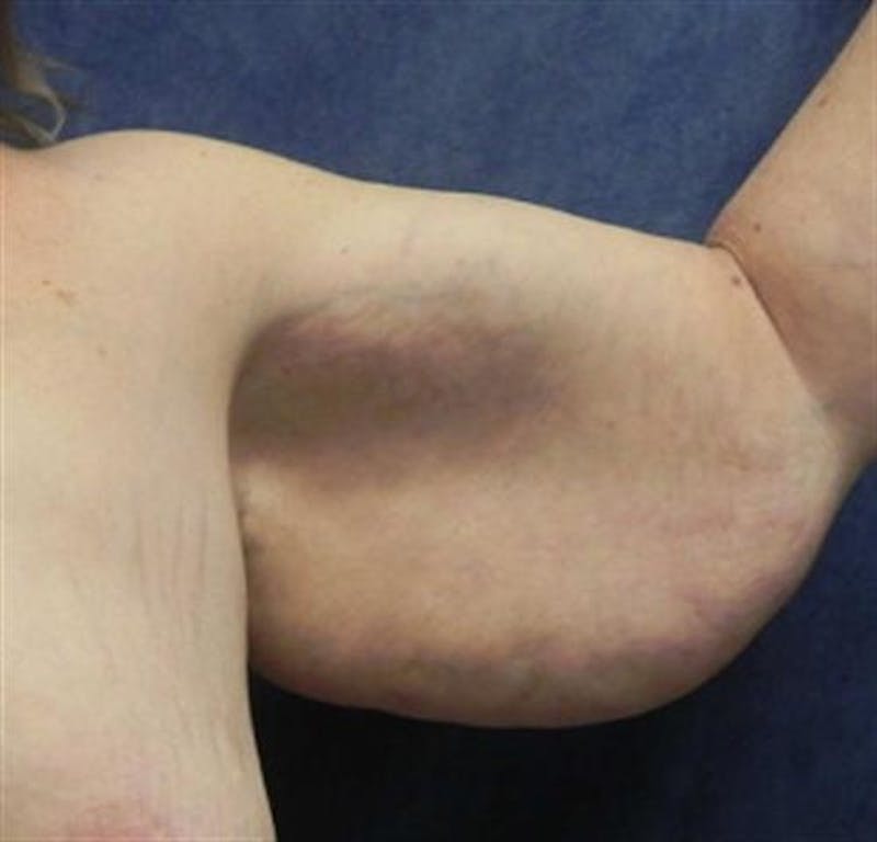 Arm Lift Before & After Gallery - Patient 260678 - Image 3