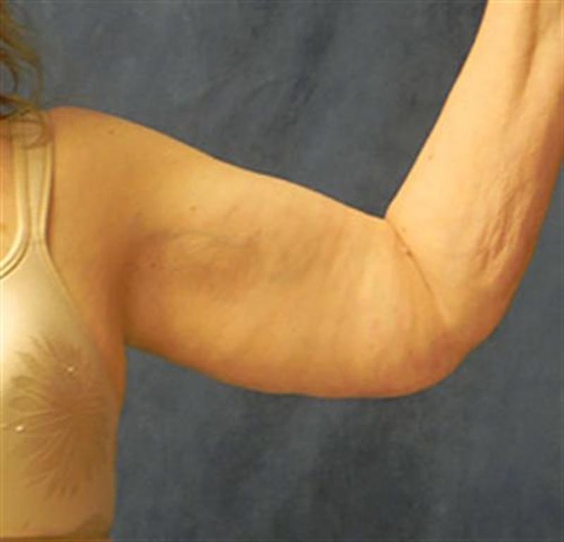 Arm Lift Before & After Gallery - Patient 260678 - Image 4