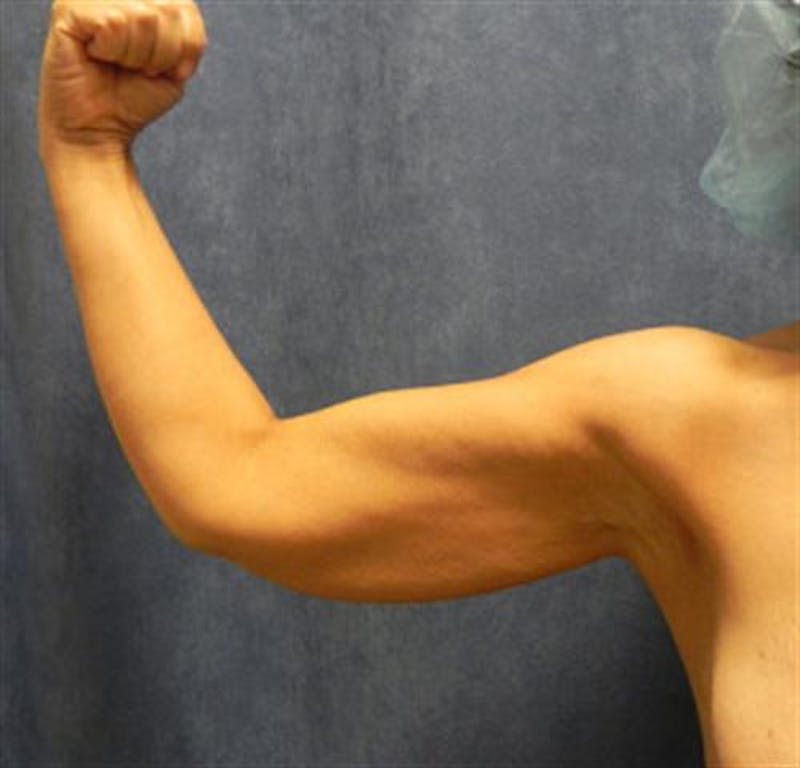 Arm Lift Before & After Gallery - Patient 216675 - Image 1