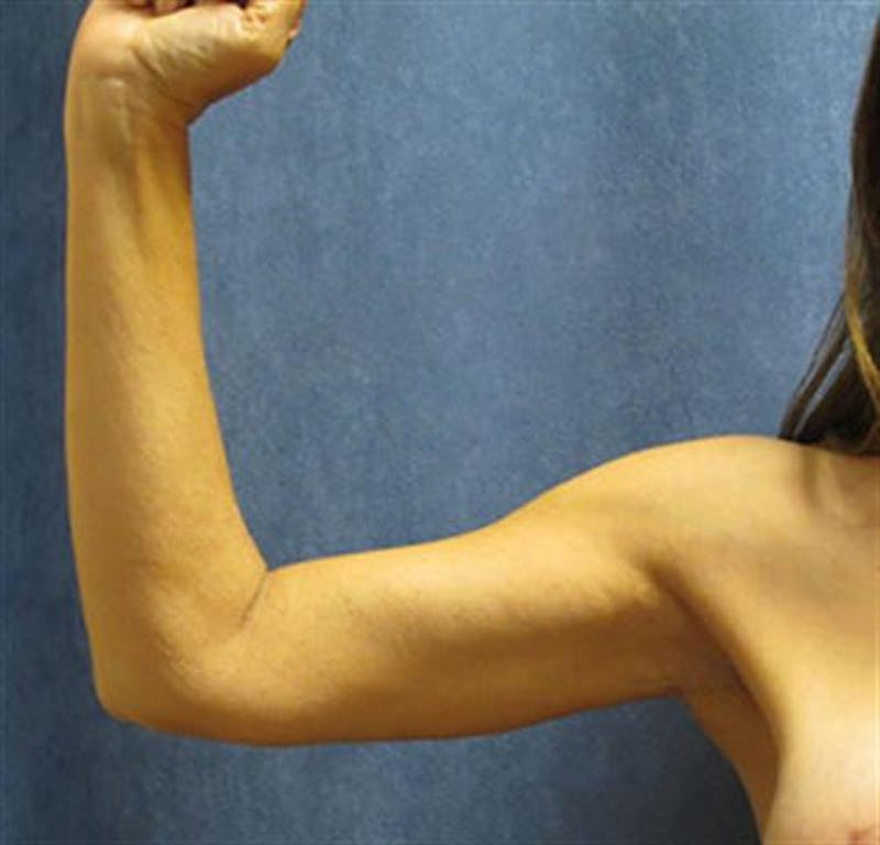 Arm Lift Before & After Gallery - Patient 216675 - Image 2