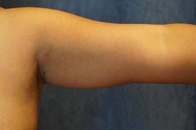 Arm Lift Before & After Gallery - Patient 381279 - Image 1