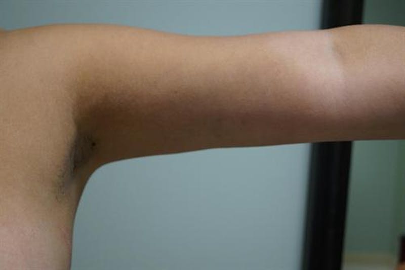 Arm Lift Before & After Gallery - Patient 381279 - Image 2