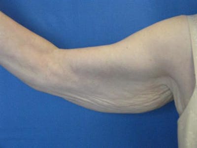Arm Lift Before & After Gallery - Patient 421058 - Image 1