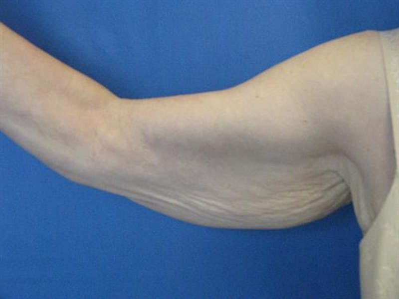 Arm Lift Before & After Gallery - Patient 421058 - Image 1