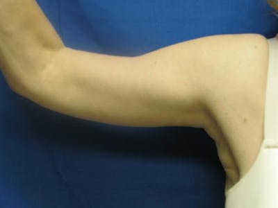 Arm Lift Before & After Gallery - Patient 421058 - Image 2