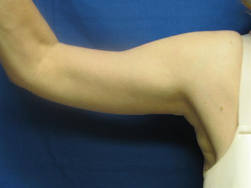 Arm Lift Before & After Gallery - Patient 421058 - Image 2
