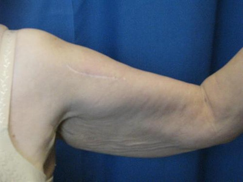 Arm Lift Before & After Gallery - Patient 421058 - Image 3