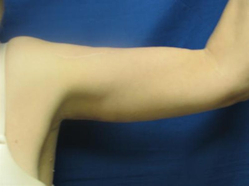 Arm Lift Before & After Gallery - Patient 421058 - Image 4