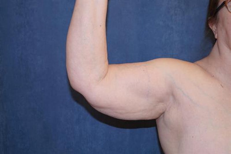 Arm Lift Before & After Gallery - Patient 105543 - Image 1
