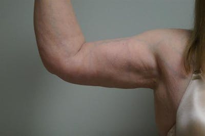 Arm Lift Before & After Gallery - Patient 105543 - Image 2