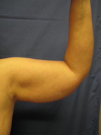 Arm Lift Before & After Gallery - Patient 614874 - Image 1