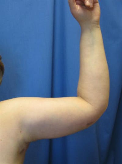 Arm Lift Before & After Gallery - Patient 614874 - Image 2
