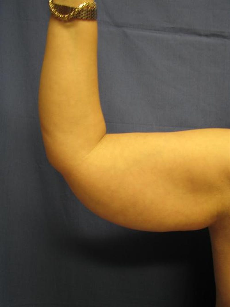 Arm Lift Before & After Gallery - Patient 681971 - Image 1