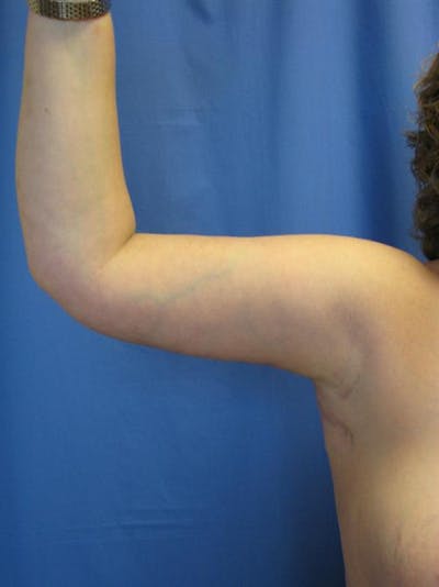 Arm Lift Before & After Gallery - Patient 681971 - Image 2
