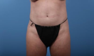 BodyTite PRO Before & After Gallery - Patient 225006 - Image 1