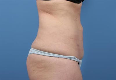 BodyTite PRO Before & After Gallery - Patient 994138 - Image 2