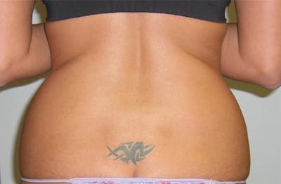 BodyTite PRO Before & After Gallery - Patient 313837 - Image 1