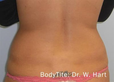 BodyTite PRO Before & After Gallery - Patient 313837 - Image 2