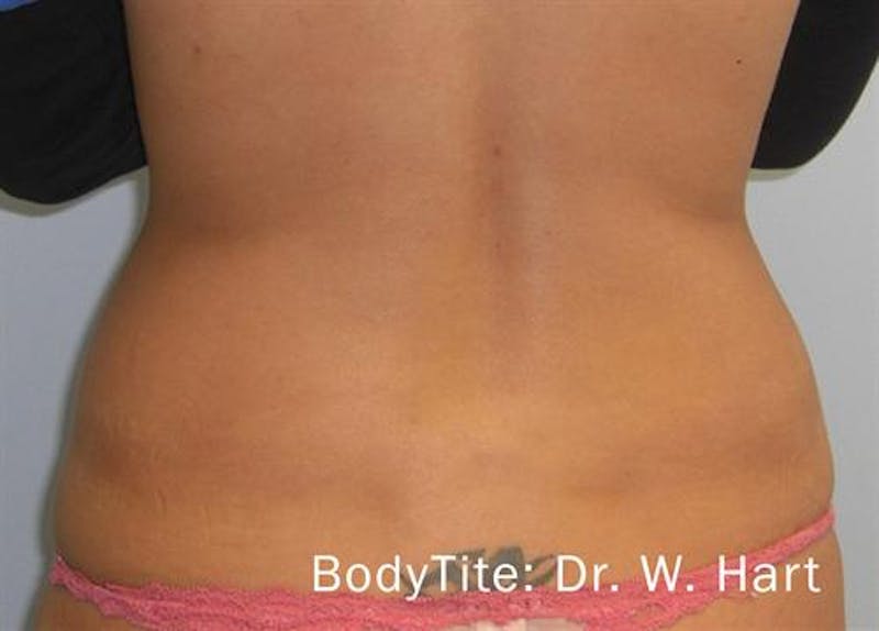 BodyTite PRO Before & After Gallery - Patient 313837 - Image 2