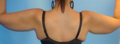 BodyTite PRO Before & After Gallery - Patient 237393 - Image 1