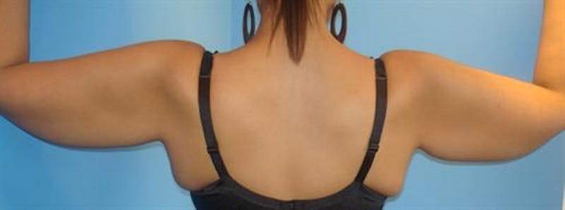 BodyTite PRO Before & After Gallery - Patient 237393 - Image 1