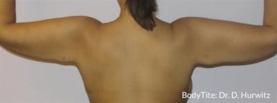 BodyTite PRO Before & After Gallery - Patient 237393 - Image 2