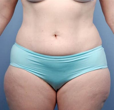 BodyTite PRO Before & After Gallery - Patient 396971 - Image 1