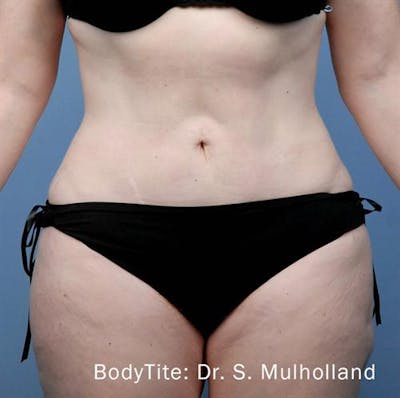 BodyTite PRO Before & After Gallery - Patient 396971 - Image 2