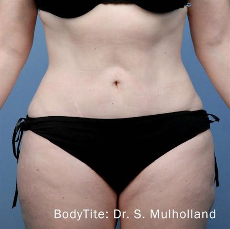 BodyTite PRO Before & After Gallery - Patient 396971 - Image 2