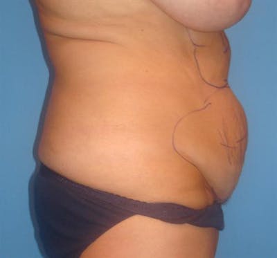 BodyTite PRO Before & After Gallery - Patient 352914 - Image 1