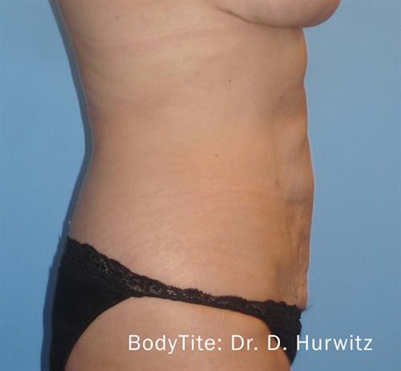 BodyTite PRO Before & After Gallery - Patient 352914 - Image 2