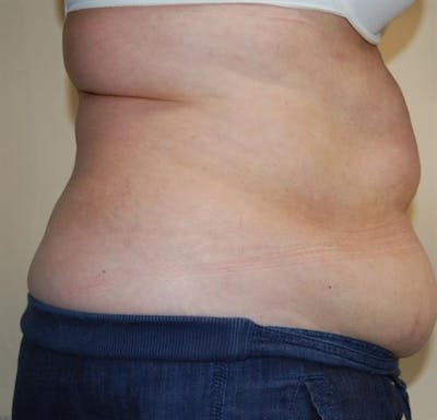 BodyTite PRO Before & After Gallery - Patient 401879 - Image 1