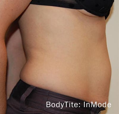 BodyTite PRO Before & After Gallery - Patient 401879 - Image 2
