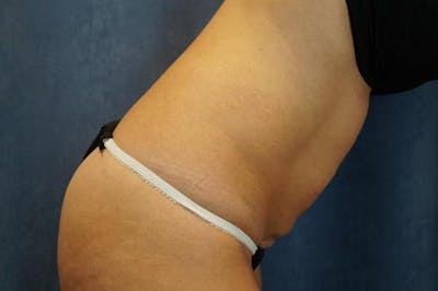 BodyTite PRO Before & After Gallery - Patient 142953 - Image 1