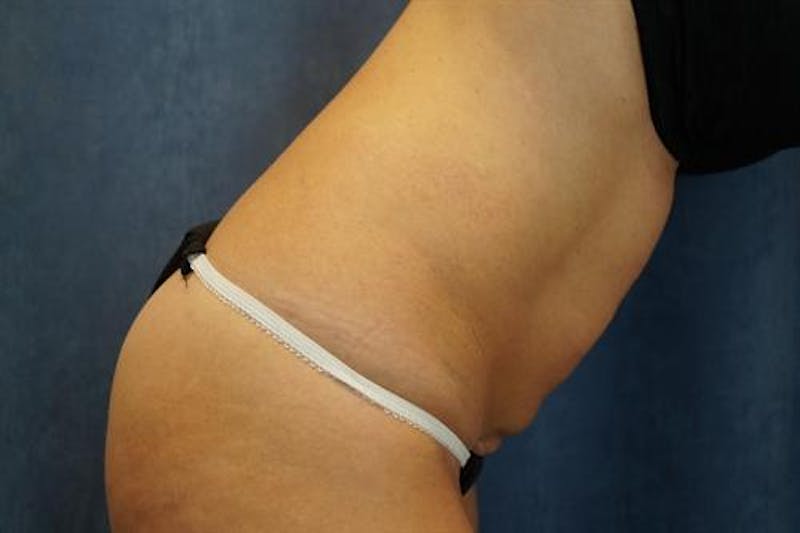 BodyTite PRO Before & After Gallery - Patient 142953 - Image 1