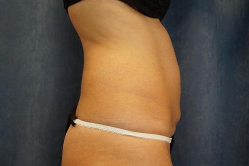 BodyTite PRO Before & After Gallery - Patient 142953 - Image 3