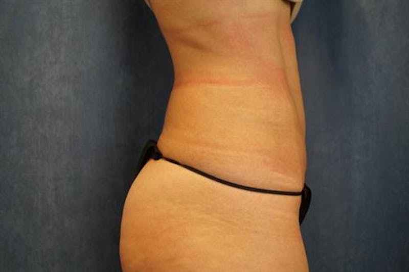 BodyTite PRO Before & After Gallery - Patient 142953 - Image 4
