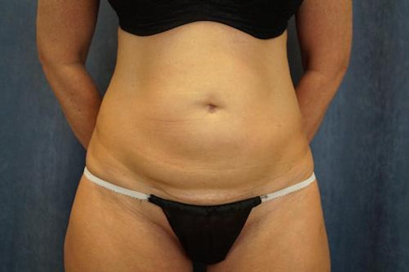 BodyTite PRO Before & After Gallery - Patient 142953 - Image 5