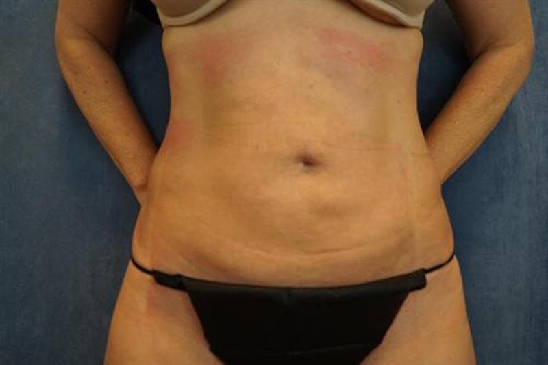 BodyTite PRO Before & After Gallery - Patient 142953 - Image 6