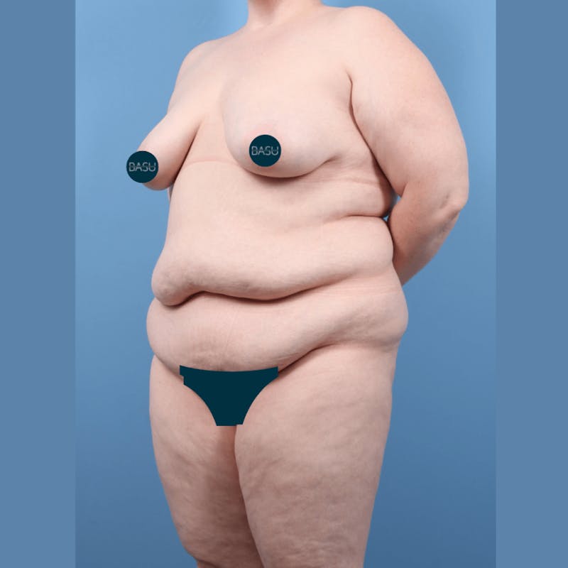 Body Lift Before & After Gallery - Patient 131098 - Image 3