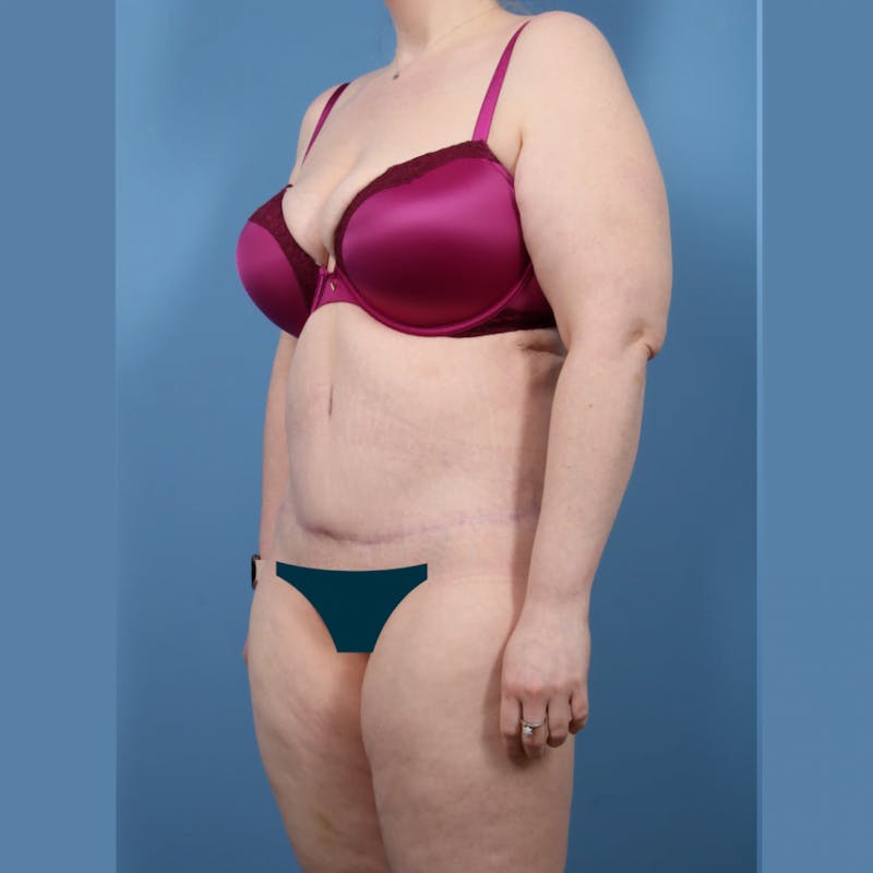Body Lift Before & After Gallery - Patient 131098 - Image 4
