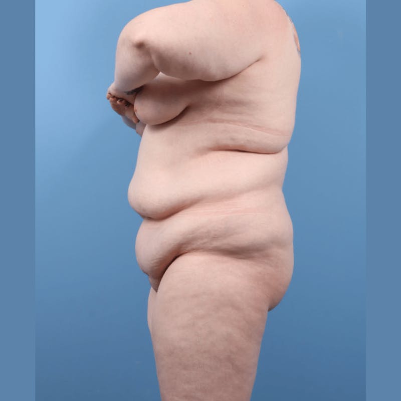 Body Lift Before & After Gallery - Patient 131098 - Image 5