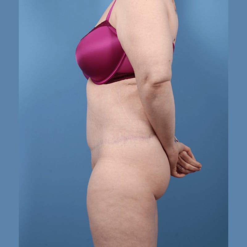 Body Lift Before & After Gallery - Patient 131098 - Image 6